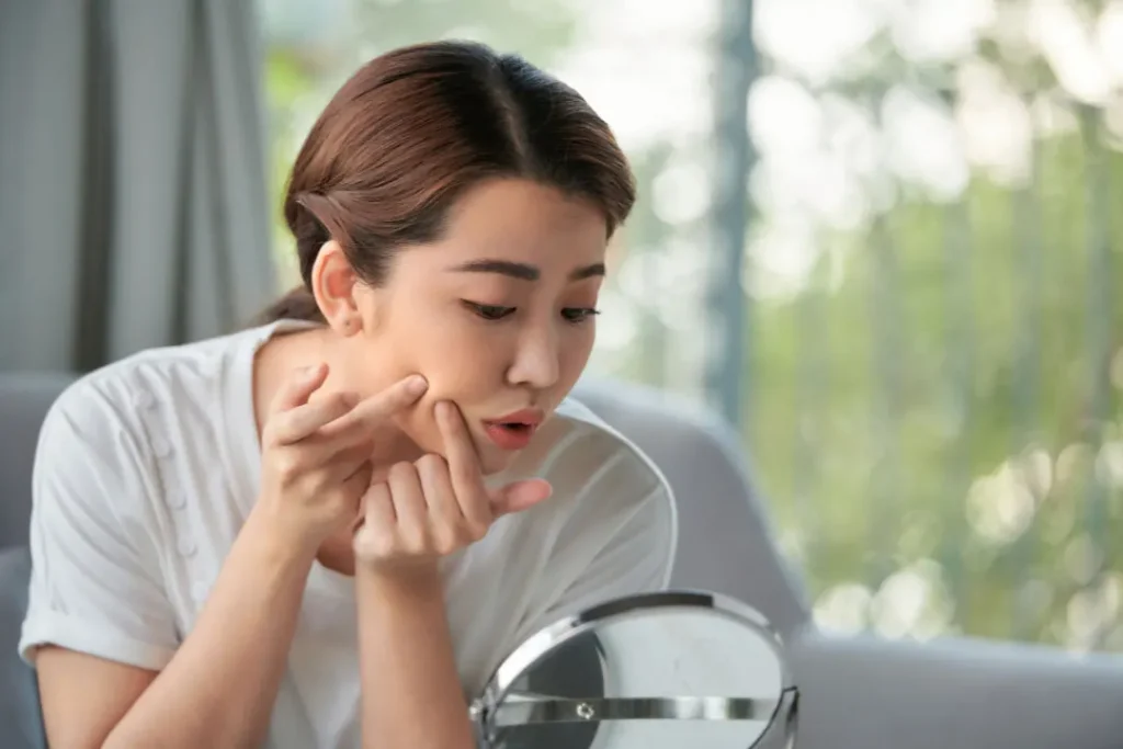 A lady having pimple on her face.