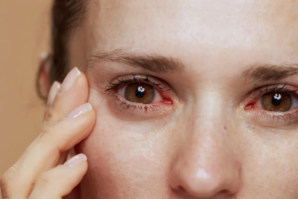 Infection in eyes.