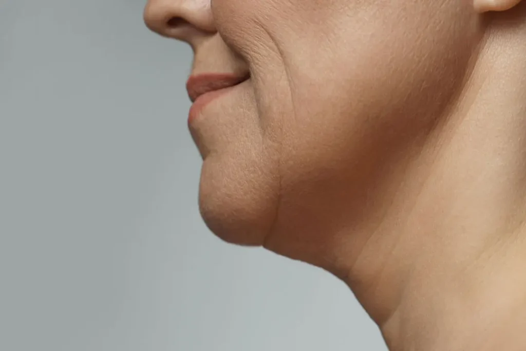 Fine lines are appeared on face.