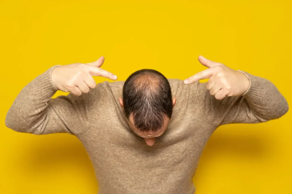 A man is going through alopecia.