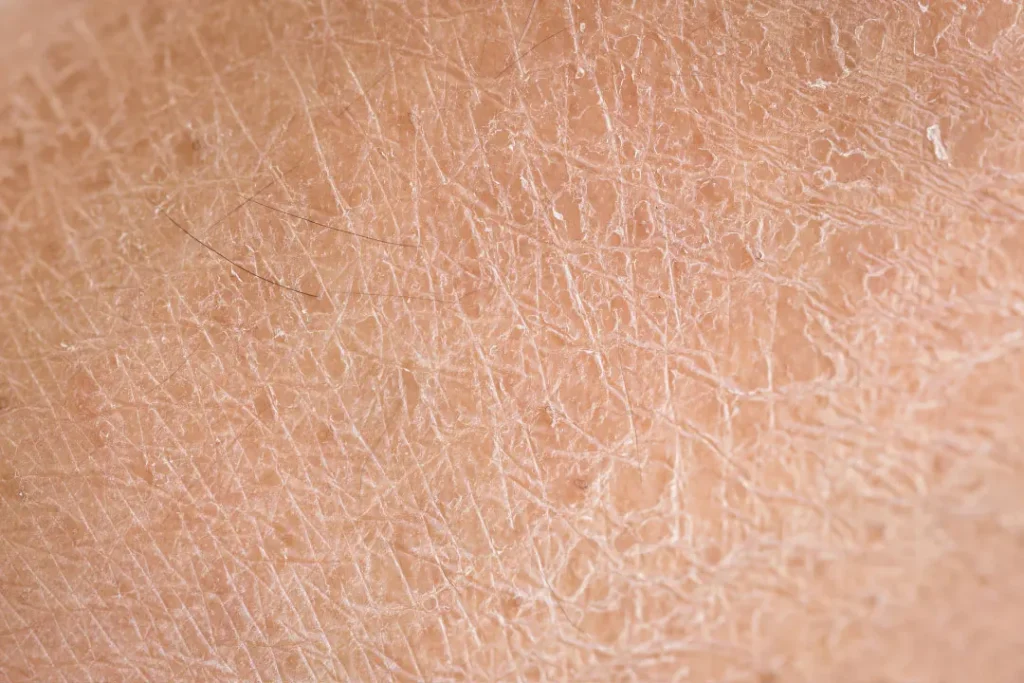 close up of dry skin