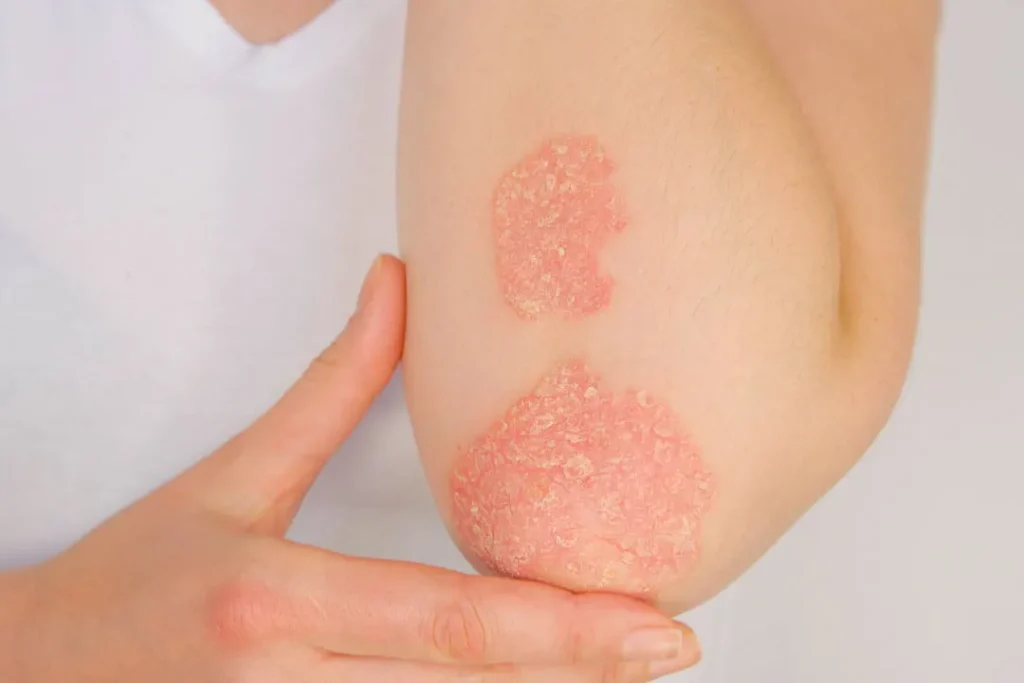Allergy spots.