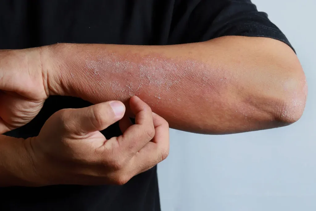 Skin allergy.
