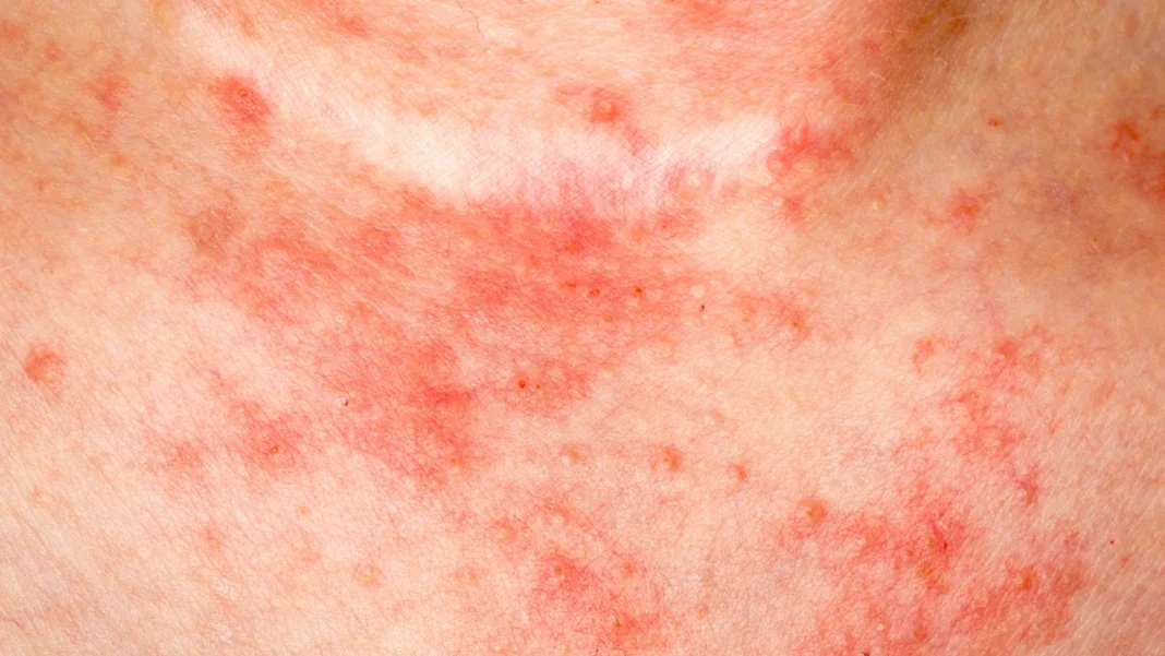 Hidradenitis suppurativa.