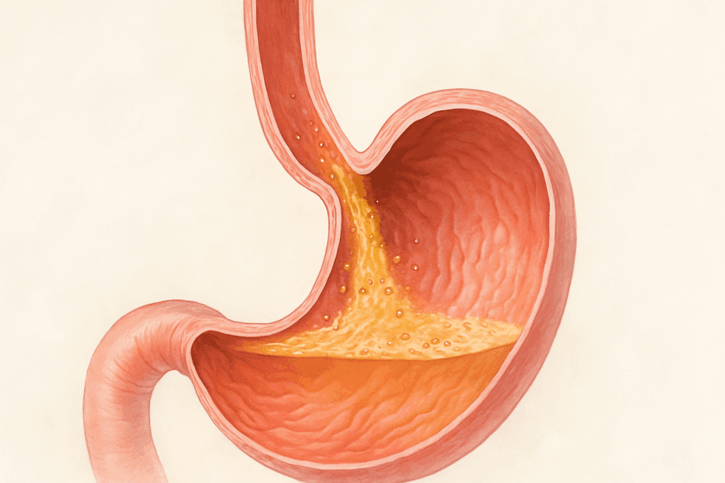 Medical illustration of acid reflux with weakened lower esophageal sphincter, showing how GERD progresses and answers can gerd cause lower abdominal pain