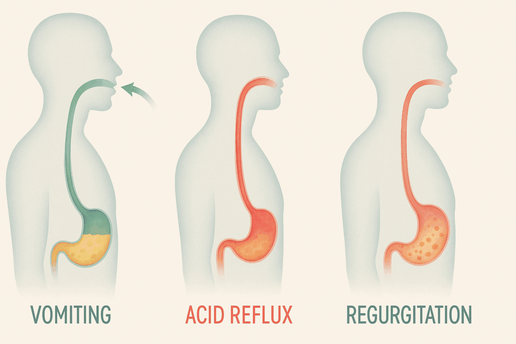 Anatomical illustration comparing what causes regurgitation, acid reflux, and vomiting with arrows showing food and acid flow in human torsos